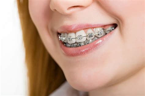 metal orthodontic bracket factory|traditional metal braces for adults.